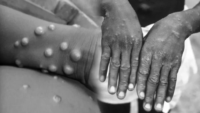 monkeypox ऑस्ट्रिया में भी मंकी पैक्स की पहला संदिग्ध केस रिपोर्ट