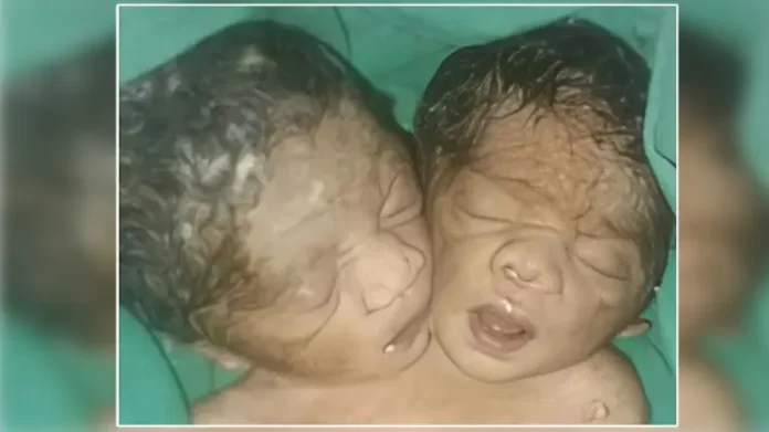 दो सिर वाले नवजात को देखकर दंग रह गए लोग